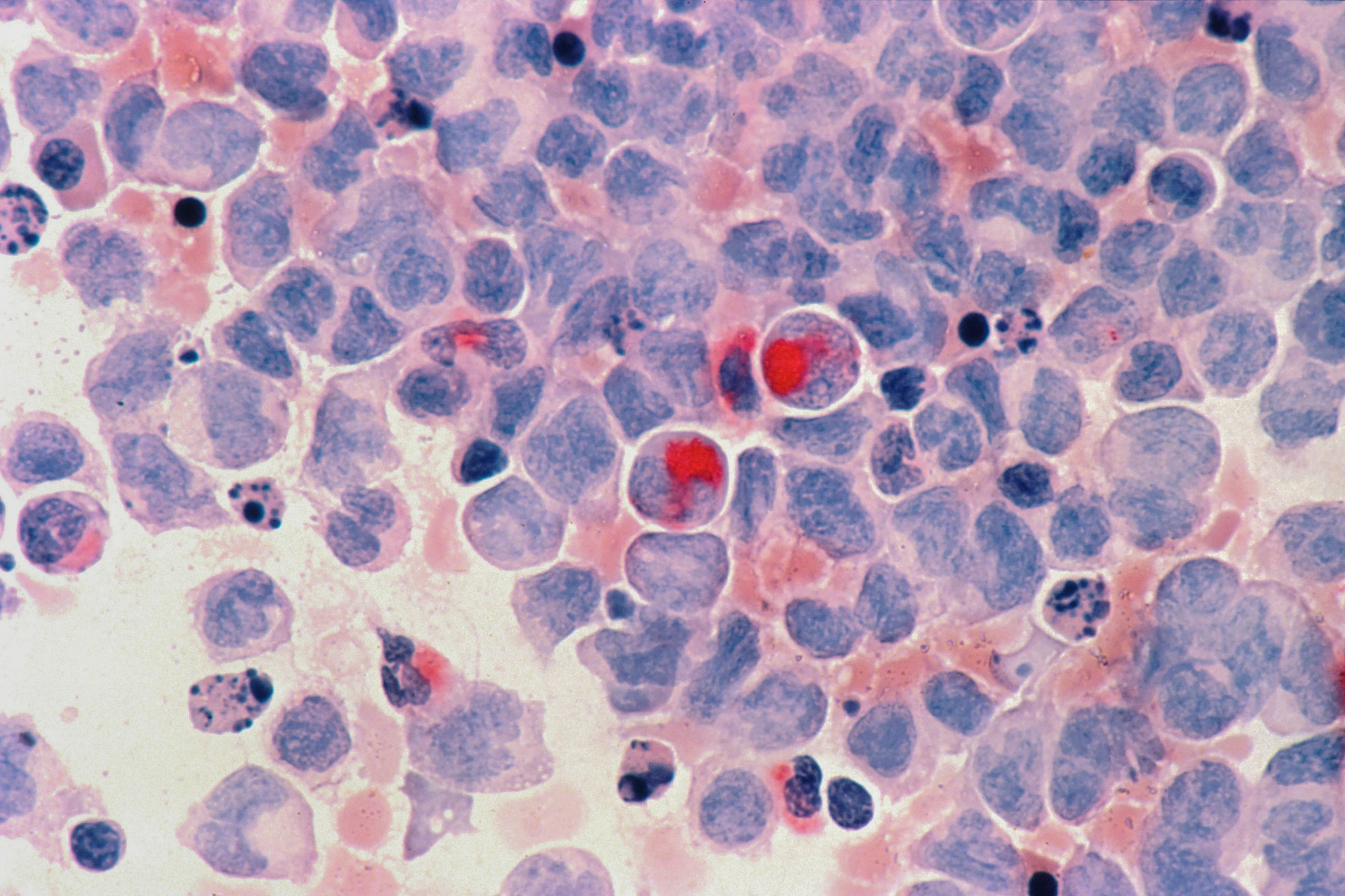 Cancer and Particulate Matter