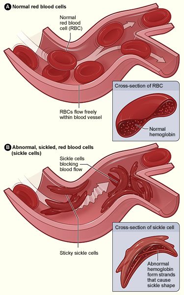 Health equity: FDA panel support for sickle cell disease cure